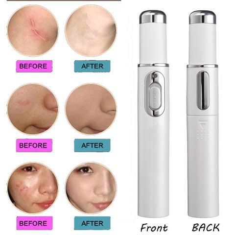 Blue Light Therapy Acne Laser Pen for Skin Care and Beauty Treatment